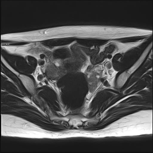 File:Bilateral ovarian endometriomas (Radiopaedia 87085-103347 Axial T2 8).jpg