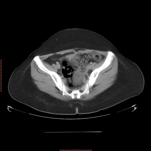 File:Bilateral ovarian serous cystadenocarcinoma with right ovarian torsion (Radiopaedia 32640-33611 A 35).jpg