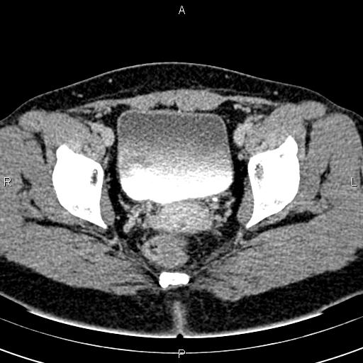 Bilateral ovarian teratoma (Radiopaedia 83131-97503 B 59).jpg