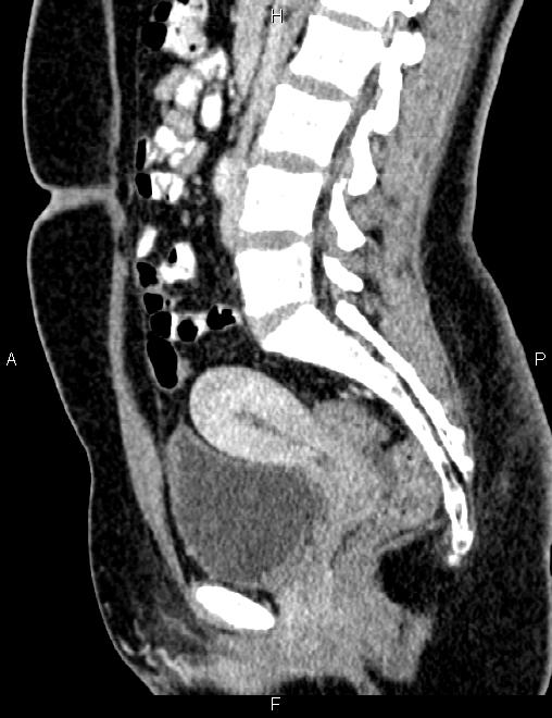 Bilateral ovarian teratoma (Radiopaedia 83131-97503 D 60).jpg