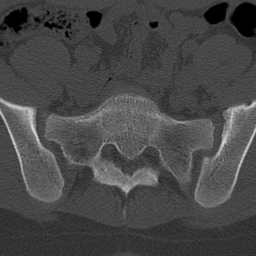 File:Bilateral pars defect (Radiopaedia 26691-26846 Axial bone window 84).jpg