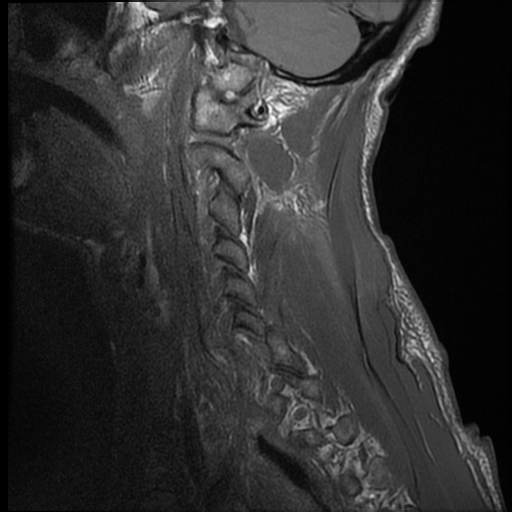 File:Bilateral perched facets with cord injury (Radiopaedia 45587-49714 Sagittal T1 15).jpg