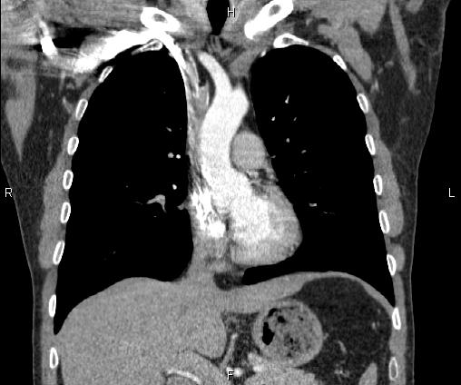 File:Bilateral pulmonary AVM (Radiopaedia 83134-97505 C 33).jpg