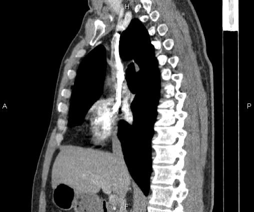 Bilateral pulmonary AVM (Radiopaedia 83134-97505 D 54).jpg