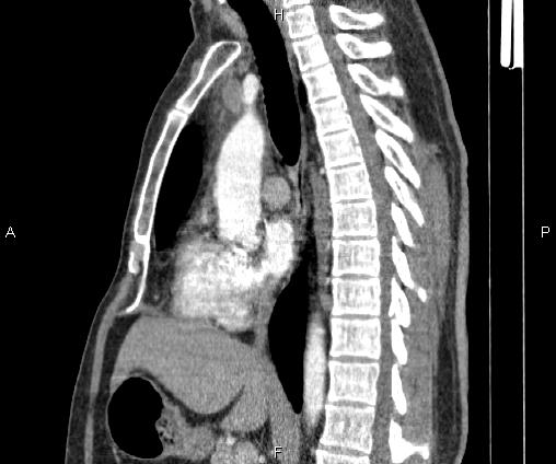 Bilateral pulmonary AVM (Radiopaedia 83134-97505 D 60).jpg