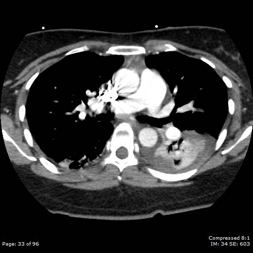 Bilateral pulmonary emboli with Hampton hump sign (Radiopaedia 54070-60246 Axial C+ CTPA 30).jpg