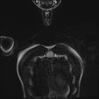 Bilateral spinoglenoid notch ganglion cysts (Radiopaedia 29577-30082 Coronal T2 9).jpg