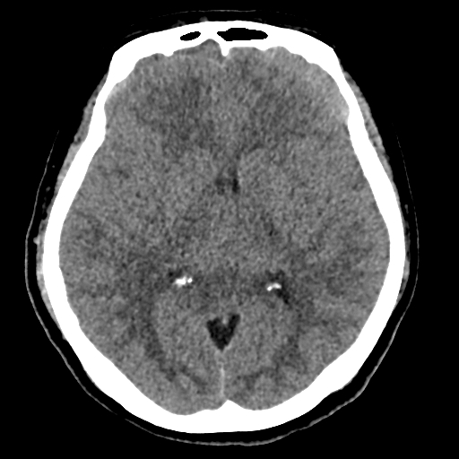 File:Bilateral subacute subdural hematoma (Radiopaedia 69240-79018 Axial non-contrast 24).jpg