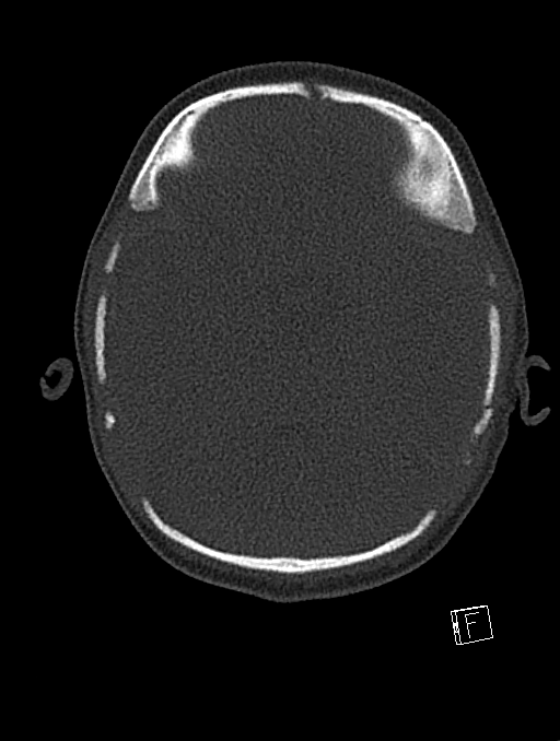 Bilateral subdural hemorrhage and parietal skull fracture (Radiopaedia 26058-26192 Axial bone window 90).png