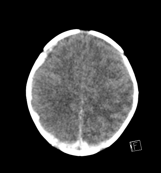 File:Bilateral subdural hemorrhage and parietal skull fracture (Radiopaedia 26058-26192 Axial non-contrast 8).png