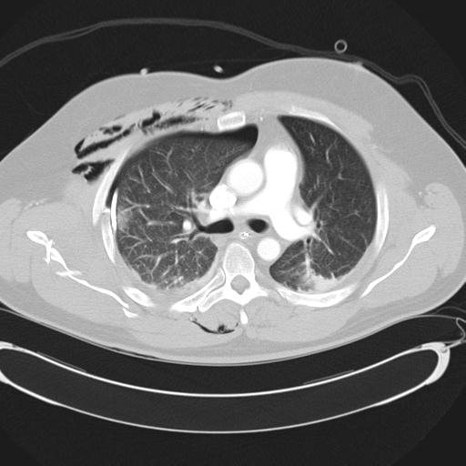 Bilateral traumatic renovascular injury (Radiopaedia 32051-32995 Axial lung window 22).jpg
