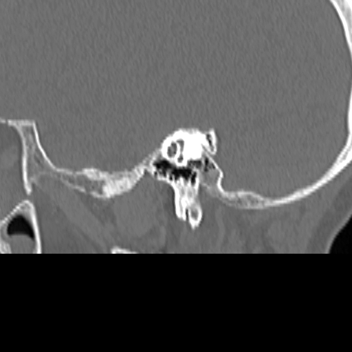 File:Bilateral tympanoplasty (Radiopaedia 16947-16664 Sagittal bone window 37).jpg