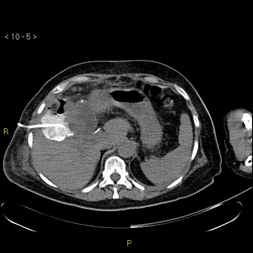 File:Biloma with drainage into the colon (Radiopaedia 20032-20068 B 5).jpg