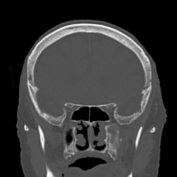 Biparietal osteodystrophy (Radiopaedia 46109-50463 Coronal bone window 39).jpg