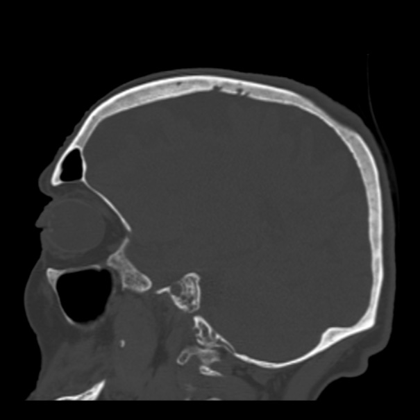 Biparietal osteodystrophy (Radiopaedia 46109-50463 Sagittal bone window 38).jpg