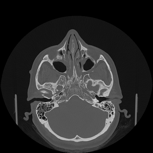 File:Bisphosphonate-related osteonecrosis of the jaw (Radiopaedia 71324-81642 Axial bone window 158).jpg