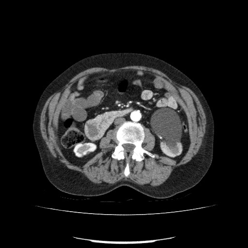 Bladder tumor detected on trauma CT (Radiopaedia 51809-57609 A 118).jpg
