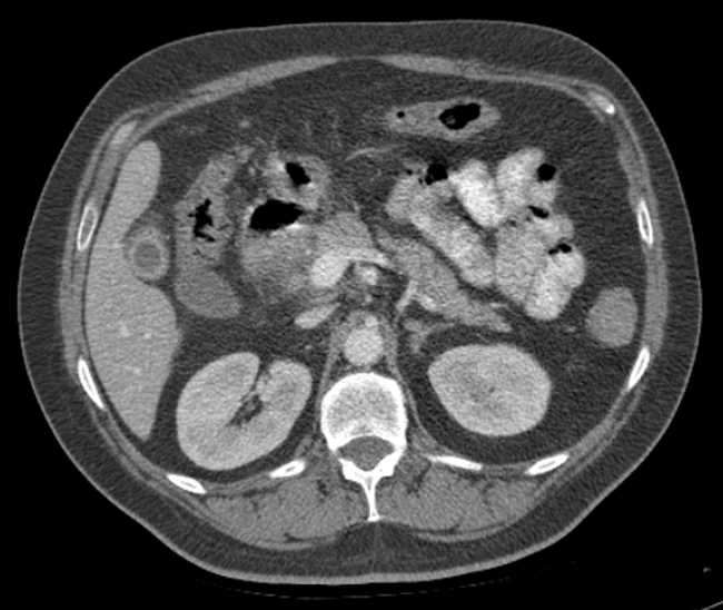 File:Bleeding duodenal ulcer and adenomyomatosis of gallbladder (Radiopaedia 61834-69861 A 38).jpg