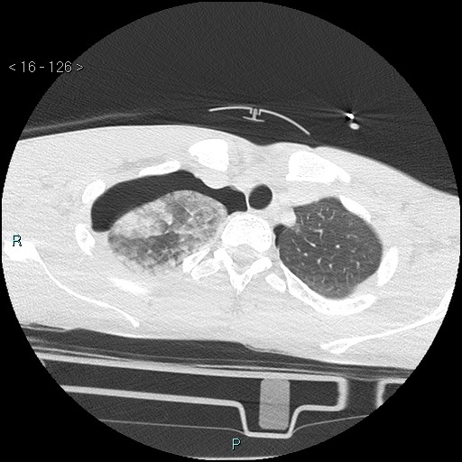Blunt chest trauma (Swiss cheese sign) (Radiopaedia 38519-40618 Axial lung window 9).jpg
