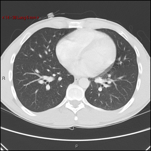 Blunt chest trauma - pulmonary interstitial emphysema and pneumomediastinum (Radiopaedia 20666-20552 Axial lung window 38).jpg