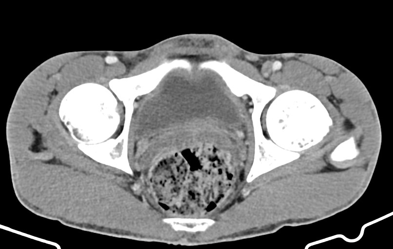 Blunt injury to the small bowel (Radiopaedia 74953-85987 A 185).jpg
