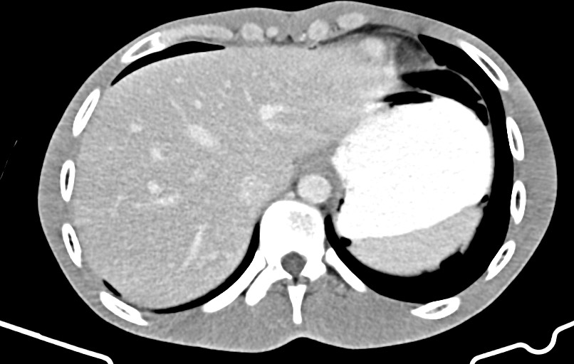Blunt injury to the small bowel (Radiopaedia 74953-85987 A 9).jpg