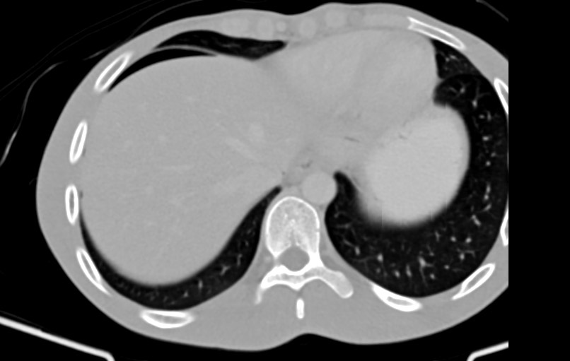 Blunt injury to the small bowel (Radiopaedia 74953-85987 Axial Wide 1).jpg
