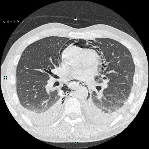 Boerhaave syndrome (Radiopaedia 27683-27897 lung window 40).jpg