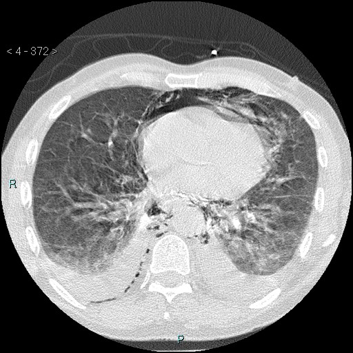 Boerhaave syndrome (Radiopaedia 27683-27897 lung window 71).jpg