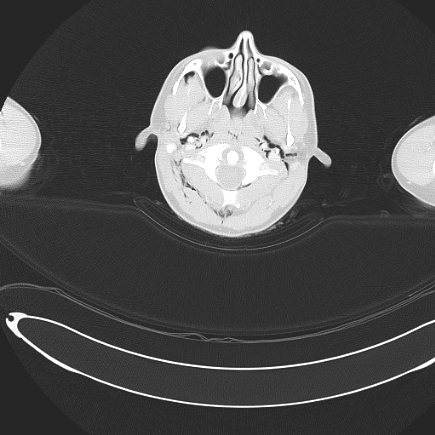 File:Boerhaave syndrome with mediastinal, axillary, neck and epidural free gas (Radiopaedia 41297-44115 Axial lung window 5).jpg