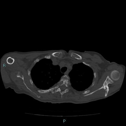 File:Bone metastases from untreated breast cancer (Radiopaedia 42973-46219 Axial bone window 24).jpg