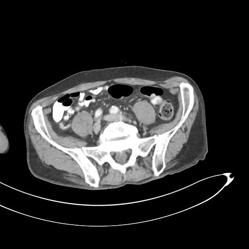Bone metastasis from squamous cell carcinoma (Radiopaedia 30133-30730 B 52).jpg