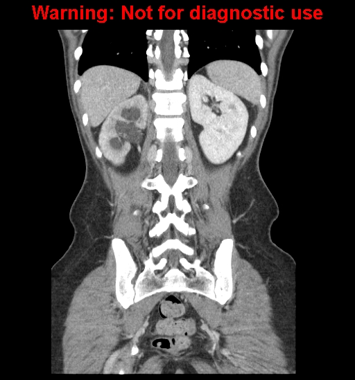 Borderline mucinous cystadenoma of ovary (Radiopaedia 25586-25767 B 52).jpg