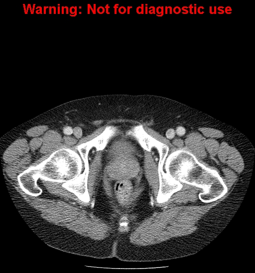 File:Bosniak renal cyst - type IV (Radiopaedia 23402-23466 D 80).jpg