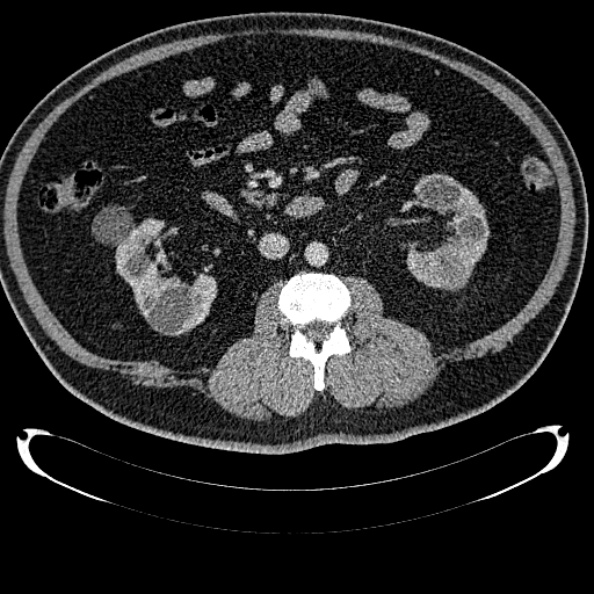 Bosniak renal cyst - type IV (Radiopaedia 24244-24518 C 175).jpg
