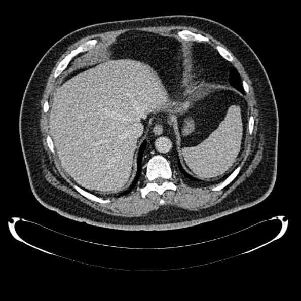 File:Bosniak renal cyst - type IV (Radiopaedia 24244-24518 C 36).jpg