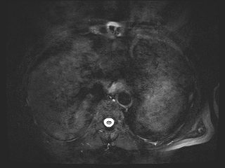 File:Bouveret syndrome (Radiopaedia 61017-68856 Axial MRCP 7).jpg