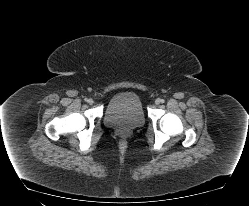 Bowel and splenic infarcts in acute lymphocytic leukemia (Radiopaedia 61055-68913 A 120).jpg
