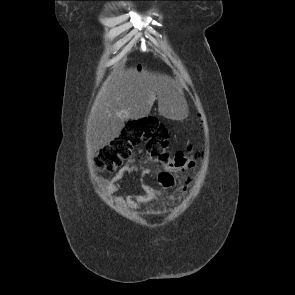 Bowel and splenic infarcts in acute lymphocytic leukemia (Radiopaedia 61055-68915 B 13).jpg