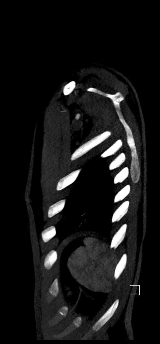 Brachiocephalic trunk pseudoaneurysm (Radiopaedia 70978-81191 C 85).jpg