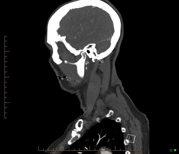 Brachiocephalic trunk stenosis (Radiopaedia 87242-103519 C 12).jpg