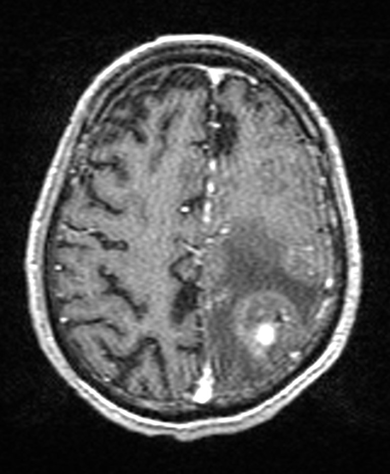 Brain abscess with dual rim sign (Radiopaedia 87566-103938 Axial T1 C+ 122).jpg