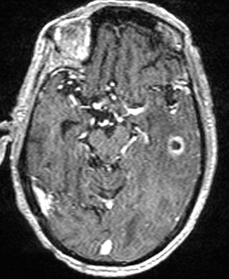 Brain abscess with dual rim sign (Radiopaedia 87566-103938 Axial T1 C+ 68).jpg