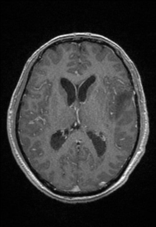Brain abscess with ventriculitis (Radiopaedia 85703-101495 Axial T1 C+ 99).jpg