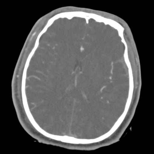 Brain contusions, internal carotid artery dissection and base of skull fracture (Radiopaedia 34089-35339 D 24).png