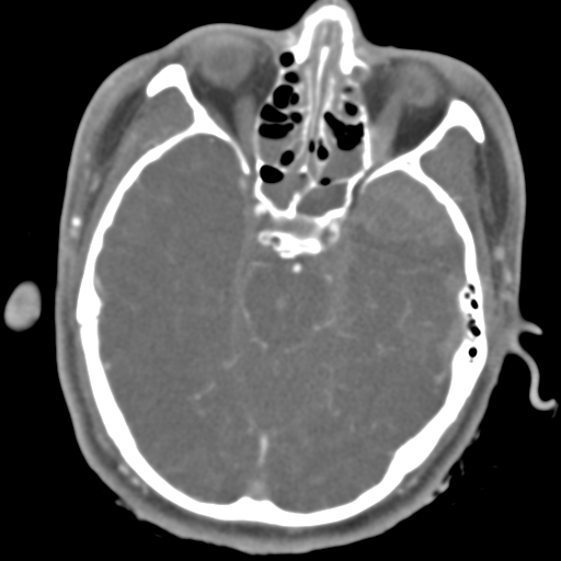 File:Brain contusions, internal carotid artery dissection and base of skull fracture (Radiopaedia 34089-35339 D 36).png