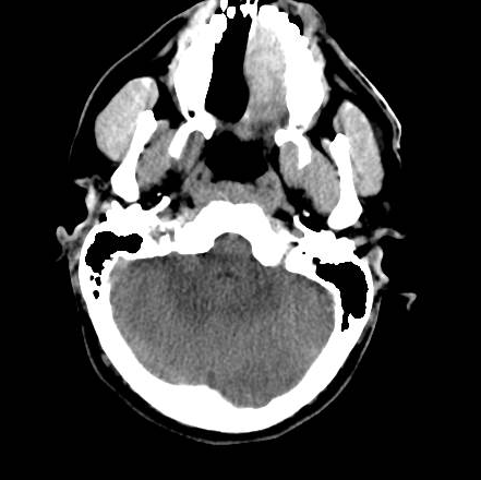 File:Brain death after motor vehicle collision (Radiopaedia 88470-105114 Axial 19).png