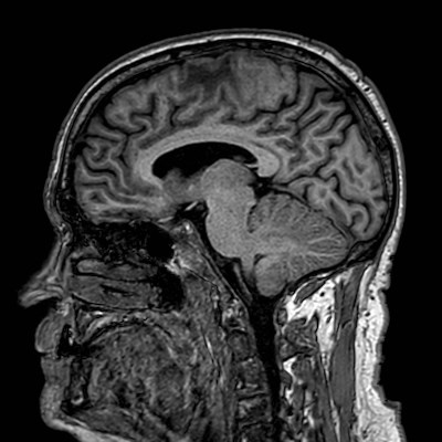 Brain metastases from lung cancer (Radiopaedia 83839-99028 Sagittal T1 71).jpg
