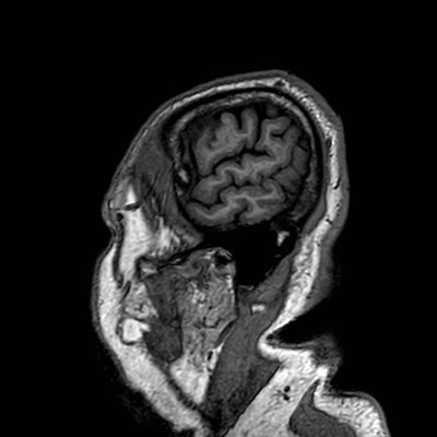 Brain metastases from lung cancer (Radiopaedia 83839-99028 Sagittal T1 8).jpg