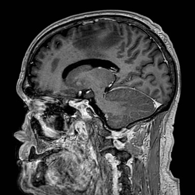 Brain metastases from lung cancer (Radiopaedia 83839-99028 Sagittal T1 C+ 38).jpg
